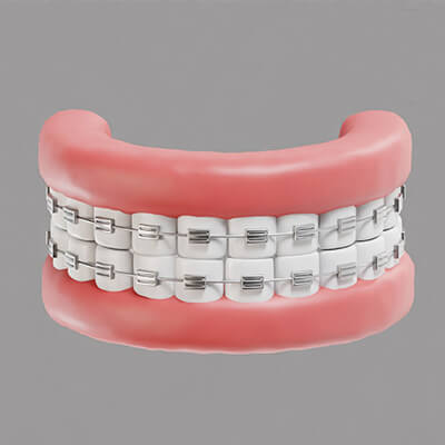 Teeth with Braces